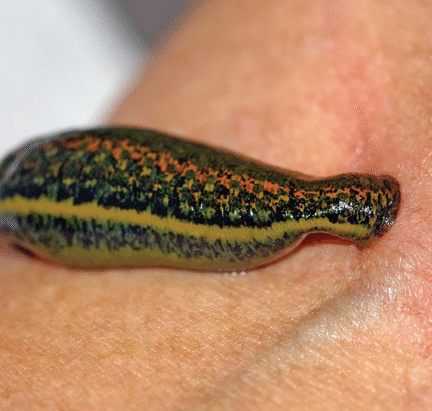 Leech therapy