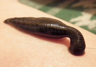 Leech therapy Leech therapy