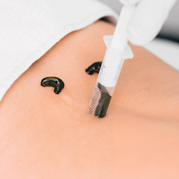 Leech therapy video