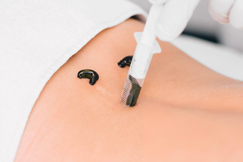 Leech therapy video Leech therapy video