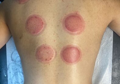 cuppings cuppings