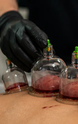 Best Hijama center in Bolingbrook